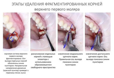 Тампоны Гемостатическая губка - «Эффективное средство для остановки сильных  кровотечений. Состав и способы применения гемостатической губки в различных  ситуациях (порез, носовое кровотечение, удаление зуба). Когда она не  поможет? » | отзывы