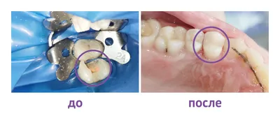 Простое удаление зуба за 10 шагов. — IMPLANT-IN.COM — дентальная  имплантация. естественно.