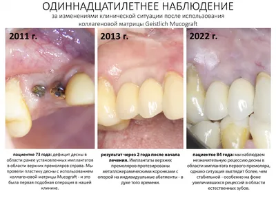 Синус-лифтинг: как это делается?