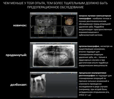 Осложнения после удаления зуба мудрости - какие могут быть, причины,  симптомы, лечение