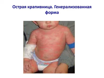 Острые аллергические реакции у детей: крапивница, ангиоотек. Лекция 11 -  online presentation