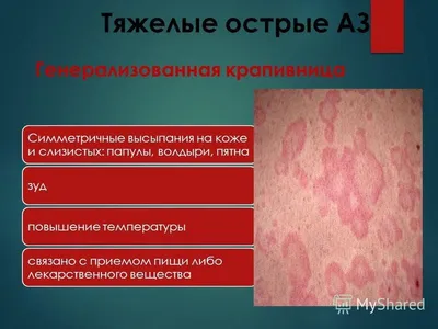 Презентация на тему: \"АЛЕРГІЧНІ ЗАХВОРЮВАННЯ. СУЧАСНІ ПІДХОДИ ДО  ЛІКУВАННЯ.\". Скачать бесплатно и без регистрации.