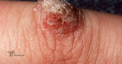 Фотоэпиляция ПМР - Что такое остроконечные кондиломы? Генитальные, или  точнее аногенитальные бородавки образуются на коже и слизистой оболочке  наружных гениталий и прианальной области. Остроконечные кондиломы - это  инфекционное заболевание, вызванное ...