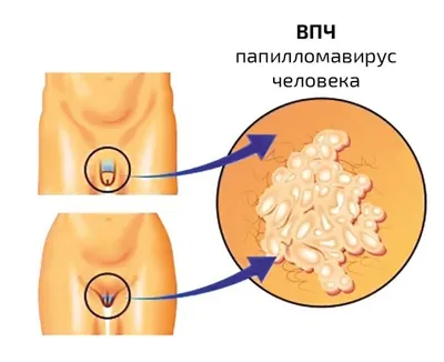 Не виноватый я! Он сам растёт!\"(c) Вирус папилломы человека | Пикабу