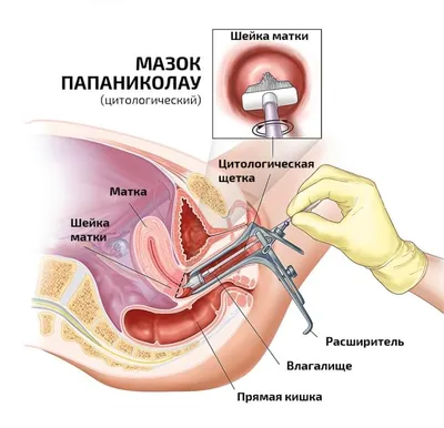 ВПЧ и беременность — Семейная Клиника