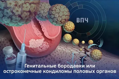Лечение остроконечных кондилом в Киеве — Derma.ua