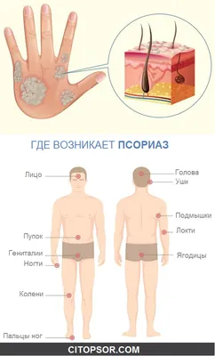 Псориаз - диагностика и лечение в частной клинике в Киеве