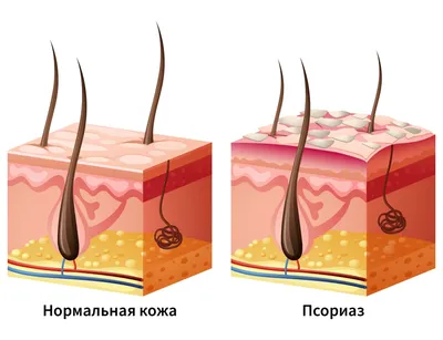 Псориаз – причины, симптомы, лечение