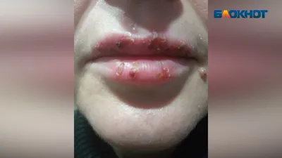 Герпес после перманентного макияжа губ — Наталья Семенова на TenChat.ru
