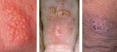 Болезнь черепицы Sympton вирус герпеса на человеческом теле Сыпь на коже и  волдырей на теле Стоковое Изображение - изображение насчитывающей боль,  микстура: 197929651