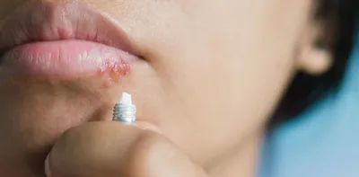Чем лечить герпес на губах: быстрое лечение | Doc.ua