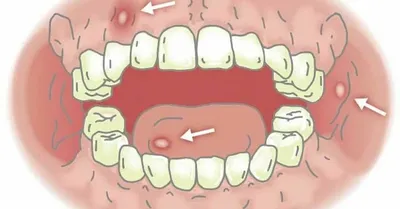 ВИЧ-инфекция: проявления в области рта при СПИДеDENTALMAGAZINE.RU