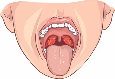 ВИЧ-инфекция: проявления в области рта при СПИДеDENTALMAGAZINE.RU