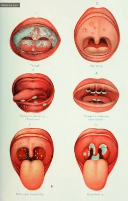 Проявления вирусных инфекций в полости рта