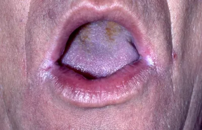 Вирус простого герпеса слизистой оболочки полости рта – тема научной статьи  по клинической медицине читайте бесплатно текст научно-исследовательской  работы в электронной библиотеке КиберЛенинка