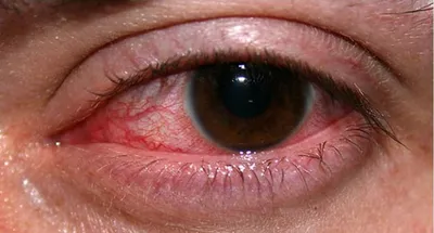 Герпес на глазу (офтальмогерпес) – причины, симптомы, лечение и диагностика  в клинике «Будь Здоров»