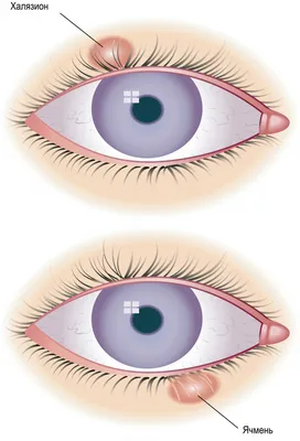 Омоложение зоны глаз Smooth-eye на аппарате Fotona - MD Beauty Clinic