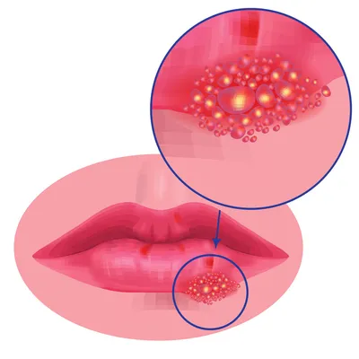 Герпес на губе — причины возникновения, симптомы и лечение в MAJOR CLINIC