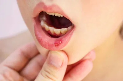 ВИЧ-инфекция: проявления в области рта при СПИДеDENTALMAGAZINE.RU