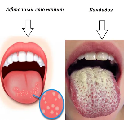 Лекарство от стоматита, препараты и средства для лечения стоматита во рту у  врослых
