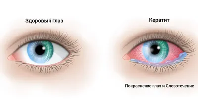 Лечение конъюнктивита у детей и взрослых: симптомы, разновидности, как и  чем лечить