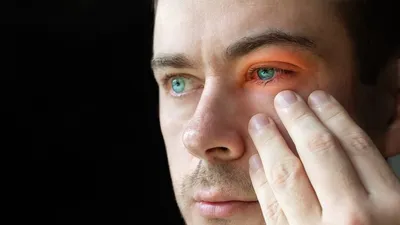 Инфекция глаза – причины, диагностика, лечение | Начни с тренировки | Дзен