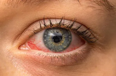 Конъюнктивит, синдром сухого глаза, красный глаз: симптомы, диагностика и  лечение