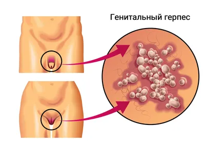 Что нужно знать о герпесе? Вирус герпеса: его типы и симптомы | Городской  кожно-венерологический диспансер