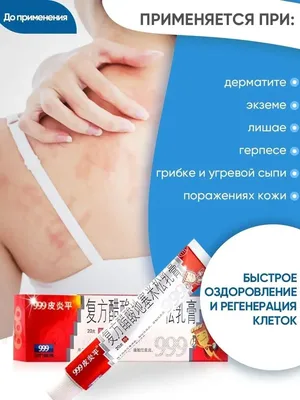 Экзема: лечение, симптомы, причины, диагностика экземы в Москве - сеть  клиник «Ниармедик»