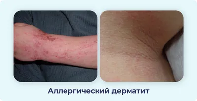 Сыпь на коже, на теле — Derma.ua