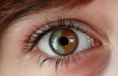Гетерохромия глаз: причины, виды и эффективное лечение заболевания