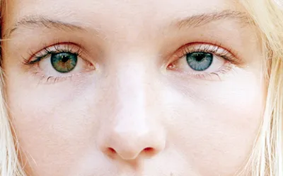 Гетерохромия глаз: причины, виды и эффективное лечение заболевания