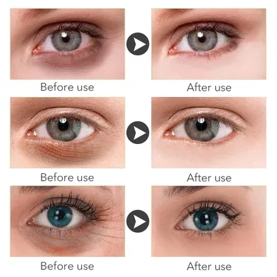 Гиалуроновая кислота улучшает темные круги и восстанавливает кожу вокруг  глаз | AliExpress