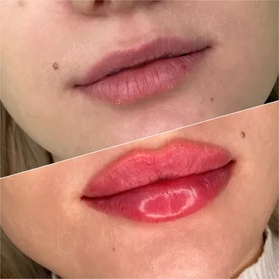 Контурная пластика губ: фото до и после