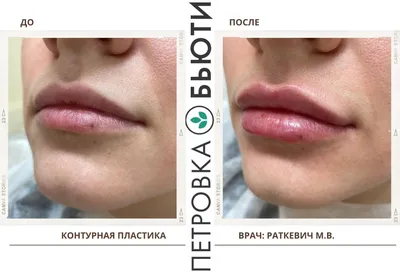 Как увеличить губы - какой филлер из гилауроновой кислоты для губ лучше -  отзывы, фото до и после