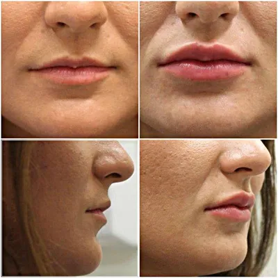 Увеличение губ с помощью уколов ботокса: силикон или гиалуроновая кислота