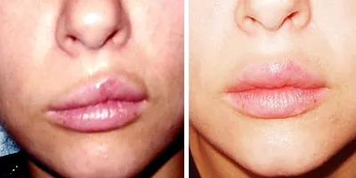 Уменьшение губ после увеличения | filler.by