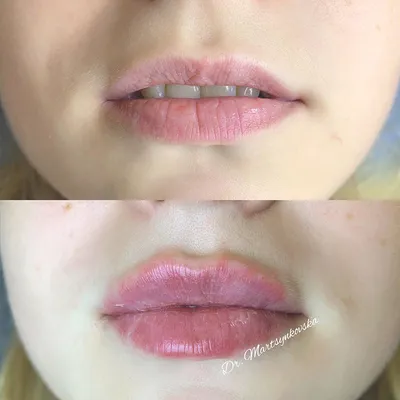 Увеличение губ гиалуроновой кислотой в Кишиневе и Харькове - фото до и после  |Honest Beauty