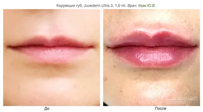 Увеличение губ гиалуроновой кислотой в Симферополе, цена, фото до и после -  Лечебно-оздоровительный комплекс VITA
