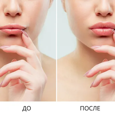 Увеличение / Аугментация губ с помощью препарата гиалуроновой кислоты - «Увеличение  губ филлером Ювидерм - увлажнённые губы, естественный объём+поднятие  уголков рта. Фото до и после» | отзывы