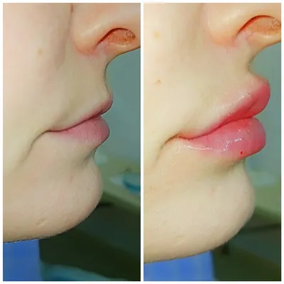 Контурная пластика губ: фото до и после