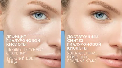 Как ухаживать за кожей вокруг глаз | Клиника эстетической медицины “Elevans”