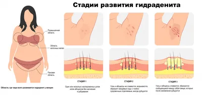 Гнойный гидраденит - причины появления, симптомы заболевания, диагностика и  способы лечения