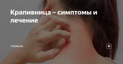 Аллергическая крапивница симптомы: опытный дерматолог в Москве.