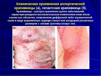 Красная сыпь на животе: симптомы и причины, что делать, прогноз