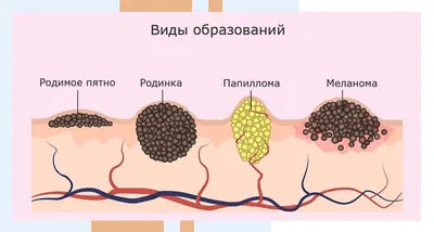 Удаление папиллом вульвы в Москве - цены в клинике АльтраВита