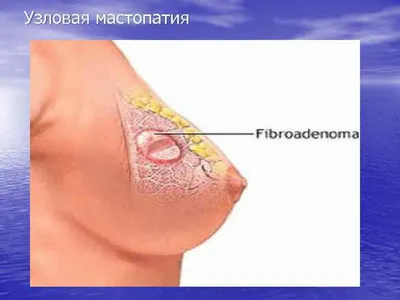 Аногенитальные бородавки: современный взгляд на проблему - Журнал Доктор Ру