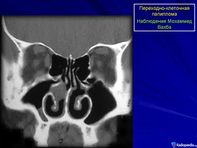 Вирус папилломы человека: что значит ВПЧ, типы HPV у мужчин и женщин |  Аллокин-Альфа