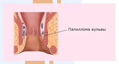 Удаление папиллом вульвы в Москве - цены в клинике АльтраВита