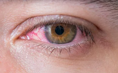 Глазная Клиника \"МедСтандарт\" в Иркутске - Опасны ли контактные линзы?⚠ .  Примерно до 2006 – 2008 года существовало широко распространённое среди  врачей мнение, что контактные линзы безопаснее, чем лазерная коррекция  зрения. Однако